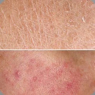 Skin Damage